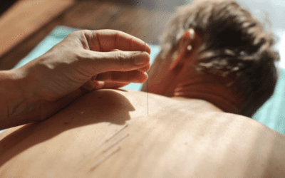 Natural Pain Relief: How Acupuncture Can Help with Chronic and Acute Pain in Albuquerque